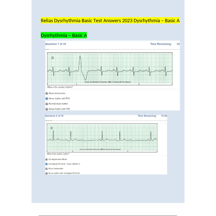 Relias Dysrhythmia Basic Test 35 Questions and Answers 2024 (Basic A Dysrhythmia)-Pass Test Bank